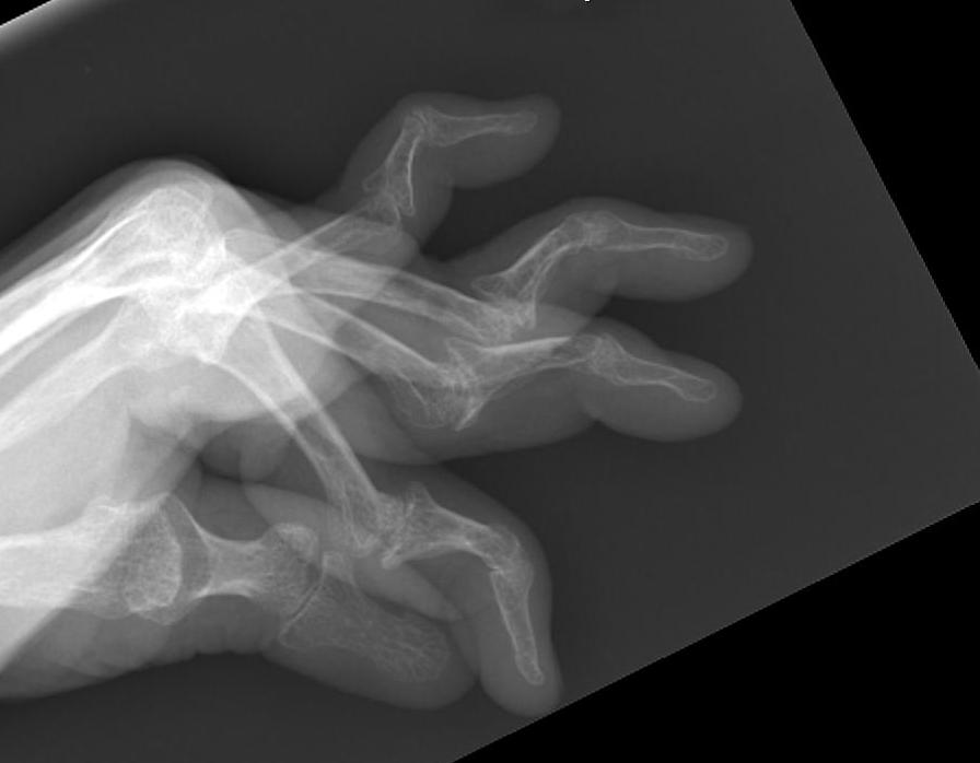 RA Swan Neck Fingers Xray